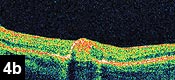 Figure 4b: Post-treatment fibrosis and resolution of fluid by optical coherence tomography