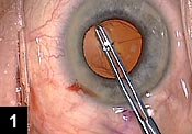 Figure 1: The capsulorrhexis edge is under the iris tissue, so its actual position is extrapolated instead of directly visualized. This allows us to create a capsulorrhexis that is larger than the pupil