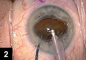 Figure 2: The nucleus is partially prolapsed through the pupil, which holds it in place. Phacoemulsification can then be performed at the iris plane