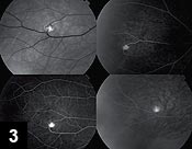 Figure 3: Fluorescein angiogram images