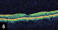 Figure 5: OCT of the macula