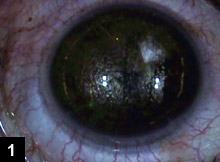 Figure 1: A 52-year-old patient who had undergone eight-incision RK in both eyes