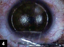 Figure 4: The flap resistance was easily overcome and lifted without any splitting of the incisions