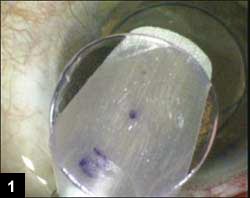 The donor cornea is placed