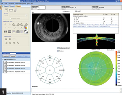 Fourier domain anterior segment OCT output screen