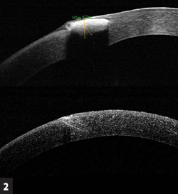 Fourier domain OCT of a foreign body in the cornea