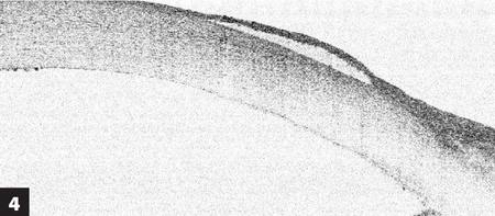 Fourier domain OCT of epithelial bullae