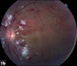 color fundus photograph, left eye