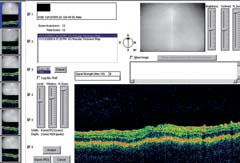 Figure 2. OCT of the macula