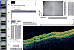 Figure 2. OCT of the macula