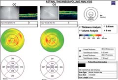 Figure 3. Overall thickness of both retinas was elevated