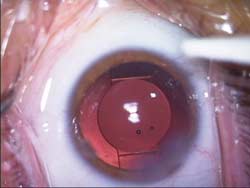 The Crysta-lens HD (Bausch & Lomb) after implantation