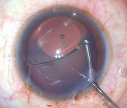 Figure 2. The visco-cannula assisted reinversion of the ICL