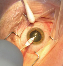 Figure 1. Incisions with roughly square internal dimensions are least likely to leak after surgery.