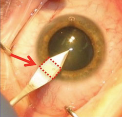 Figure 2. Incisions with roughly square internal dimensions are least likely to leak after surgery.