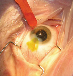 Figure 3. Even small wound leaks that are visible only with fluorescein staining can affect postoperative outcome.