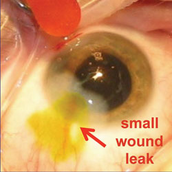 Figure 4. Even small wound leaks that are visible only with fluorescein staining can affect postoperative outcome.