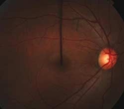 Figure 1a. Fundus image of right eye