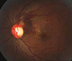 Figure 1b. Fundus image of left eye