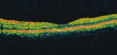 Figure 2a. OCT of left macula showing no fluid