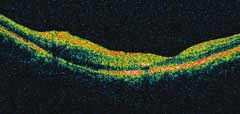 Figure 2b. OCT of left macula showing no fluid