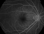 Figure 3a. Fluorescein angiography of left eye 