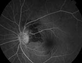 Figure 3b. Fluorescein angiography of left eye