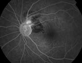 Figure 3c. Fluorescein angiography of left eye