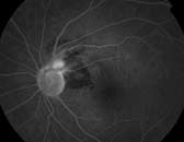 Figure 3d. Fluorescein angiography of left eye