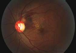 Figure 4a. Color fundus photgraph showing improvement