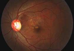 Figure 4b. Color fundus photgraph showing improvement