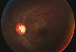 Figure 4c. Color fundus photgraph showing improvement