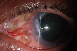 Figure 1. Anterior segment photo of left eye