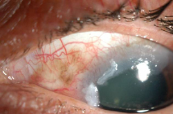 Figure 2. Anterior segment photo of the left eye