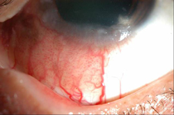 Figure 3. Anterior segment photo of the left eye