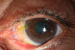 Figure 4. Anterior segment photo of left eye