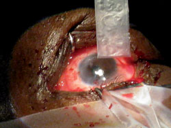 Placement of amniotic graft post pterygium