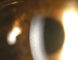 Slit lamp appearance of corneal guttae and mild corneal haze