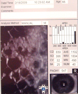 Specular microscopic evaluation