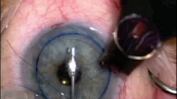 Figure 13. The 10-0 nylon suture is introduced into the anterior chamber by a Kuglen hook