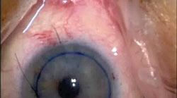 Figure 15. The graft unfolds spontaneously in the anterior chamber