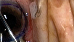 Figure 16. 20-gauge forceps, lenticule and Busin glide move simultaneously into wound