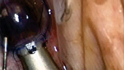 Figure 18. Graft entry into anterior chamber is facilitated by anterior chamber maintainer