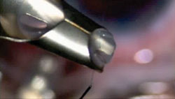 Figure 4. The suture advances through the graft