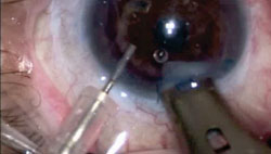 Figure 7. Traction on suture facilitates entry of graft