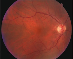 Posterior examination showed clear media, healthy optic nerve heads and normal vasculature.