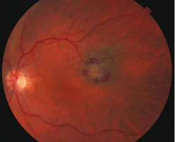 Posterior examination showed clear media, healthy optic nerve heads and normal vasculature.