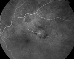 Fluorescein angiogram demonstrated early lacy hyperfluorescence and prominent leakage on later phases. 