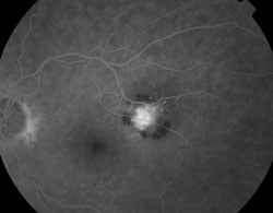 Fluorescein angiogram demonstrated early lacy hyperfluorescence and prominent leakage on later phases. 