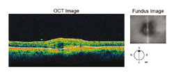 OCT showed a fragmented RPE-choriocapillaris band with edematous overlying retina and minimal subretinal fluid.